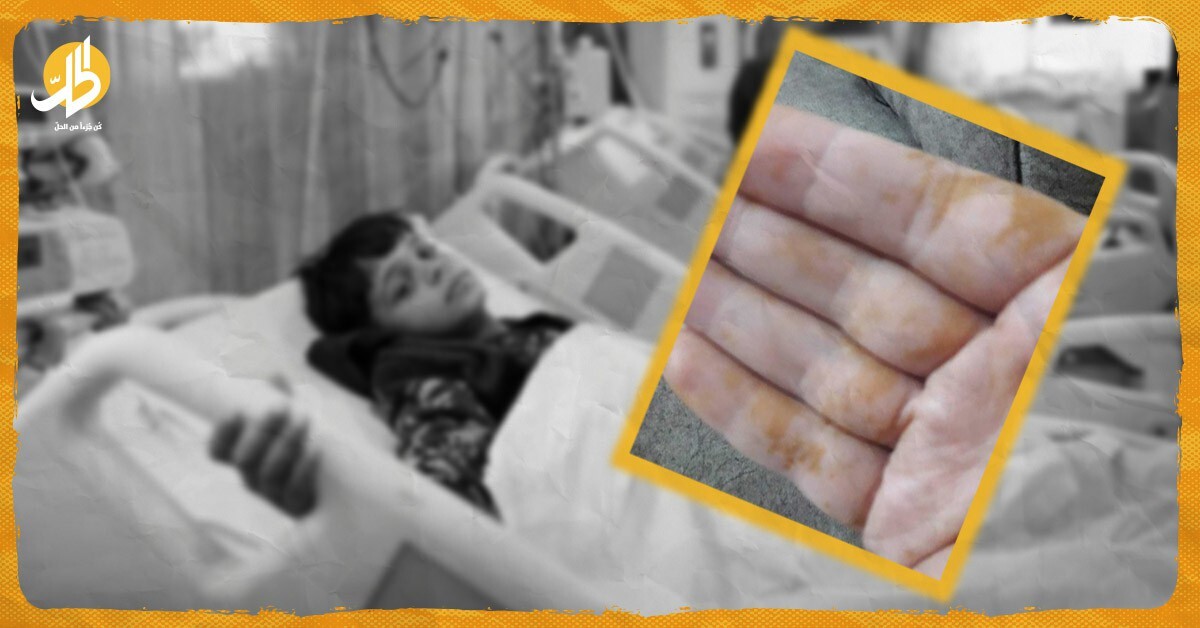 بقع غريبة على الأجساد.. سوريون متخوفون من انتشار وباء جديد في البلاد!