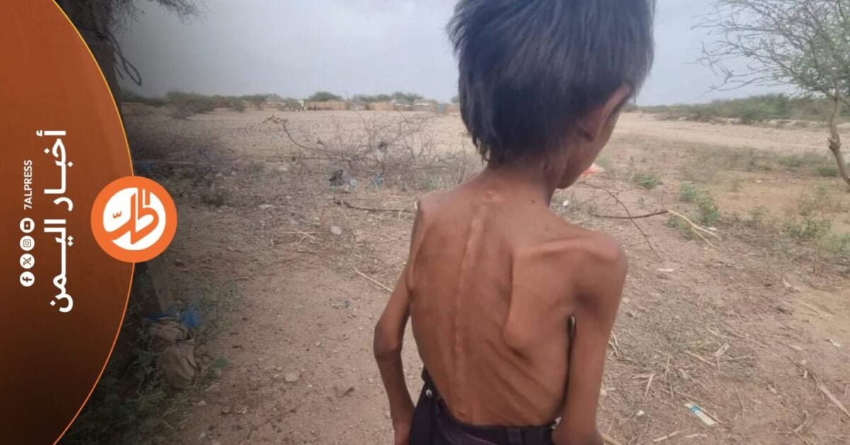 الجوع يتسع في اليمن.. وتحذيرات أممية من تفاقم الأزمة